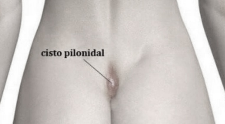 Cisto Pilonidal