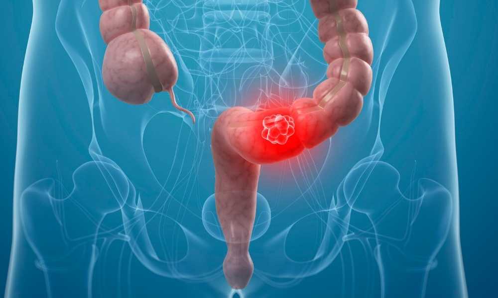 Câncer colorretal: o que você precisa saber sobre prevenção e diagnóstico